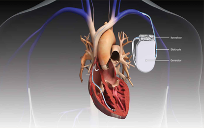 Pacemaker Implantation